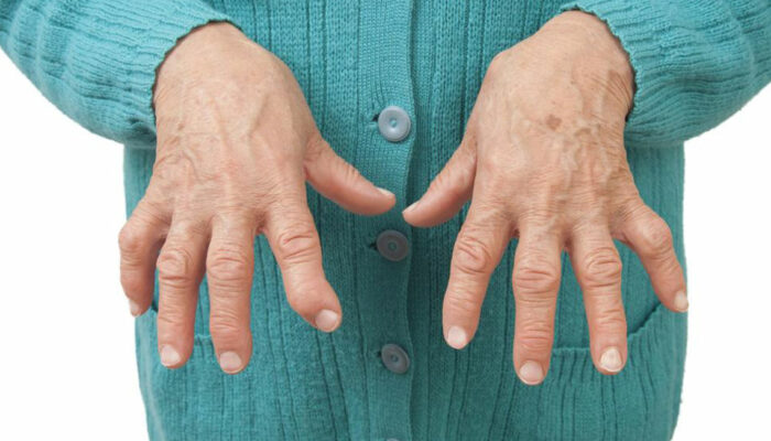 Types of arthritis and ways to deal with them